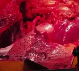 Lung expansion during surgery is carried out using special instruments to min...