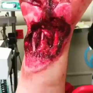 Wrist injury sustained as a result of a car accident  In the video, you can o...