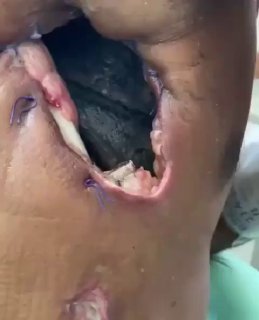 Empyema is when pus accumulates in the chest instead of air.  Such a complica...