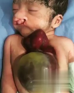 Heart Outside the Chest.   In this rare case, the child's heart was located o...