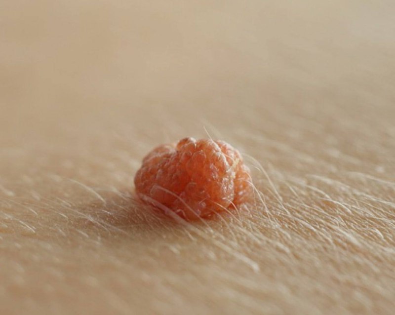 Papillomas will fall off and all parasites will come out overnight, if you ap...