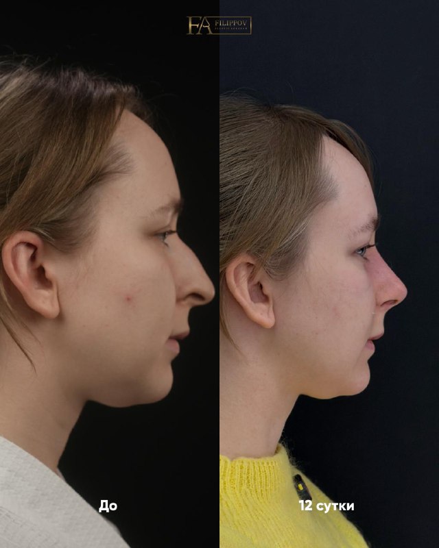 12 ДНЕЙ ПОСЛЕ ЗАКРЫТОЙ РИНОПЛАСТИКИ    Пациентка обратилась с пожеланием немн...