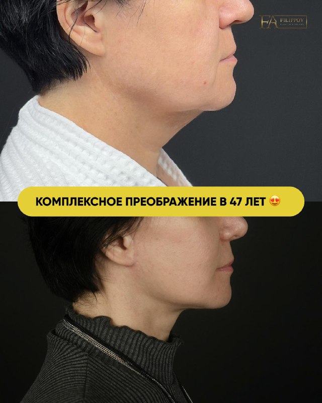 Омоложение за одну операцию  Пациентке 47 лет. После снижения веса на 15 кг с...