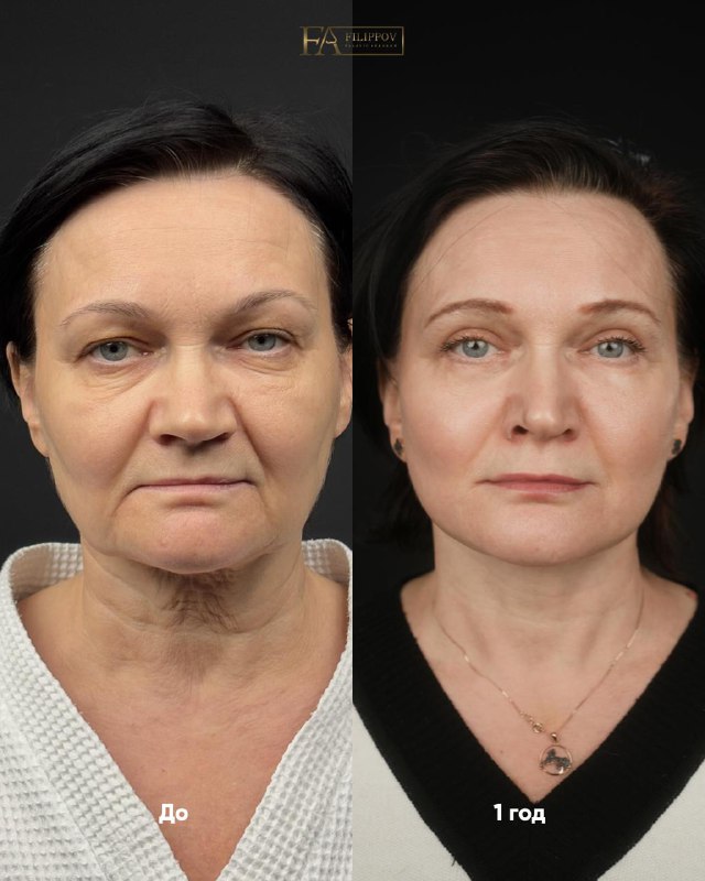 1 ГОД ПОСЛЕ ОПЕРАЦИИ    Пациентка - от природы обладательница четких контуров...