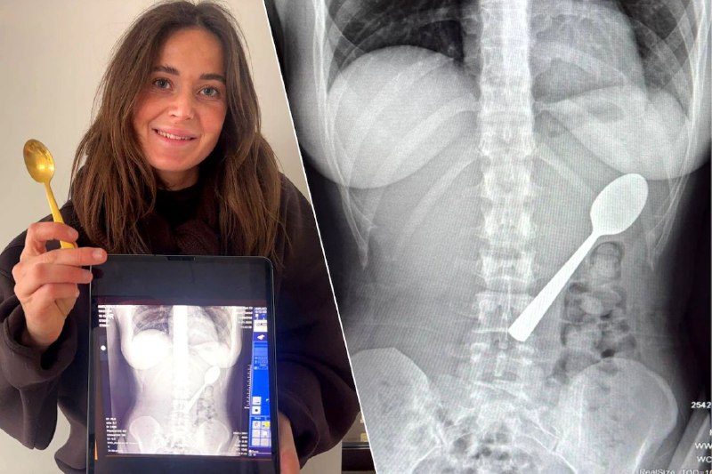 Belgique : elle avale une cuillère de 17 cm pour éviter d’étouffer !  Une jeu...