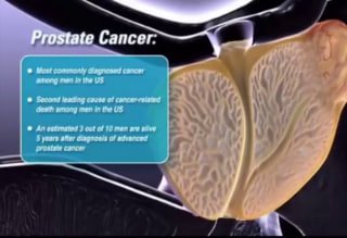 Развитие рака простаты, чаще встречается у мужчин старше 40лет. Определенную ...