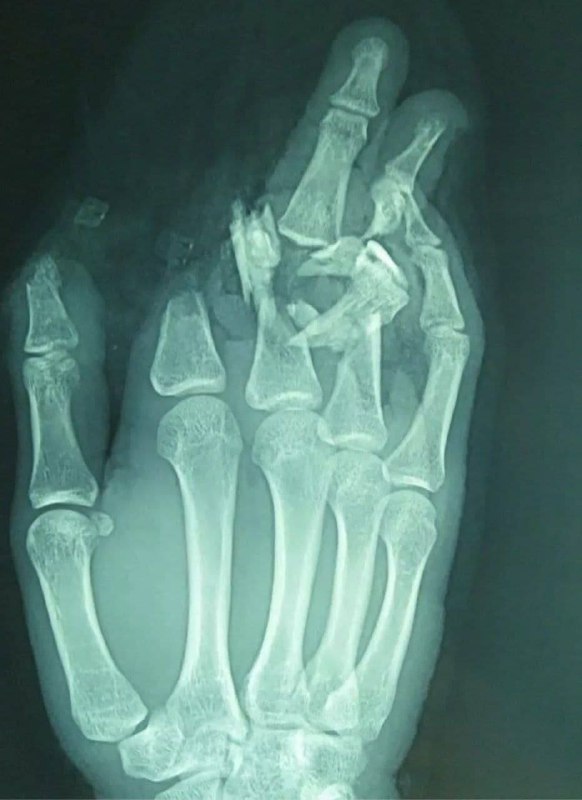 Производственная травма. Рука 20-летнего пациента попала в мясорубку