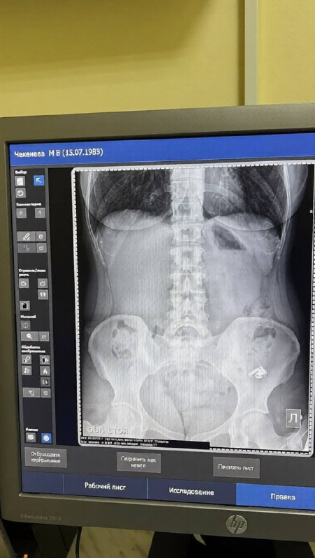 Жительница Уфы случайно проглотила беспроводной наушник, перепутав его с табл...