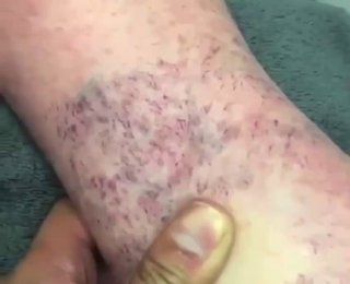 'Паучьи' вены, которые отчётливо видны на этом видео по-научному называются '...