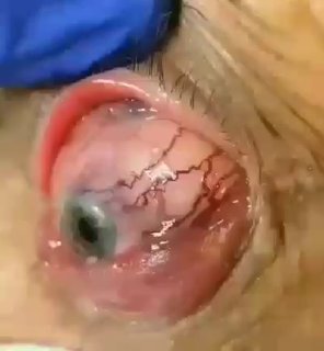 Сонно-кавернозный анастомоз   Анастомоз - это сообщение полостей, которые в н...